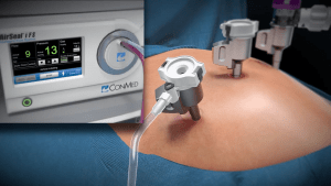 Inicio insuflación con solución robótica AirSeal® iFS